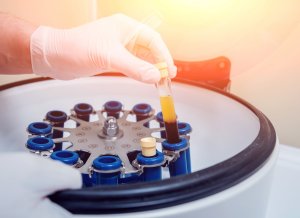 platelet rich plasma