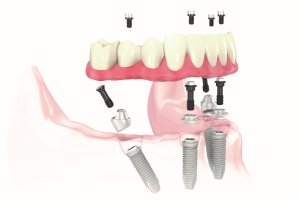 All-On-4 Treatment