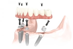 All-On-4 dental implants